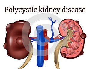 Polycystic kidney disease. genetic disease.